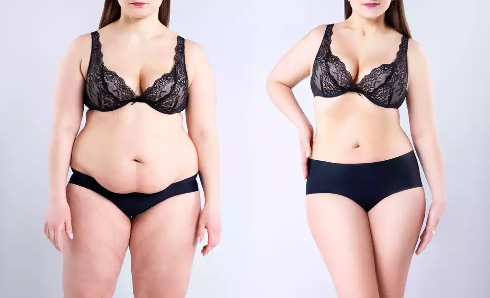 Gastric Sleeve Benefits 